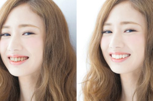 【画像あり】歯磨きだけでどこまで歯が白くなるのか、アラサー女子が検証してみました。