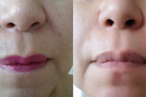 ４０代のクッキリシワが〇〇でむきたてたまご肌に…！？テレビで紹介され芸能人も絶賛した新成分とは！？
