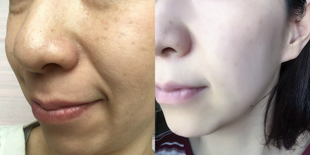 ビフォーアフター　シワ