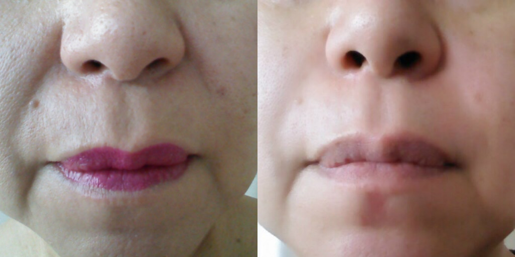 ビフォーアフター　シワ